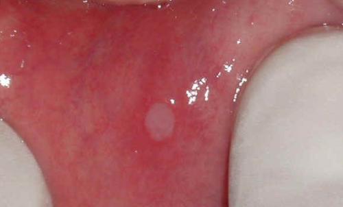 Causas, tratamientos y prevención de úlceras en la boca